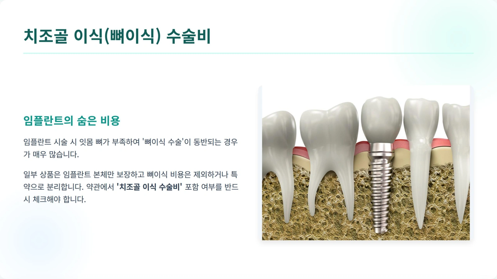 치조골 이식